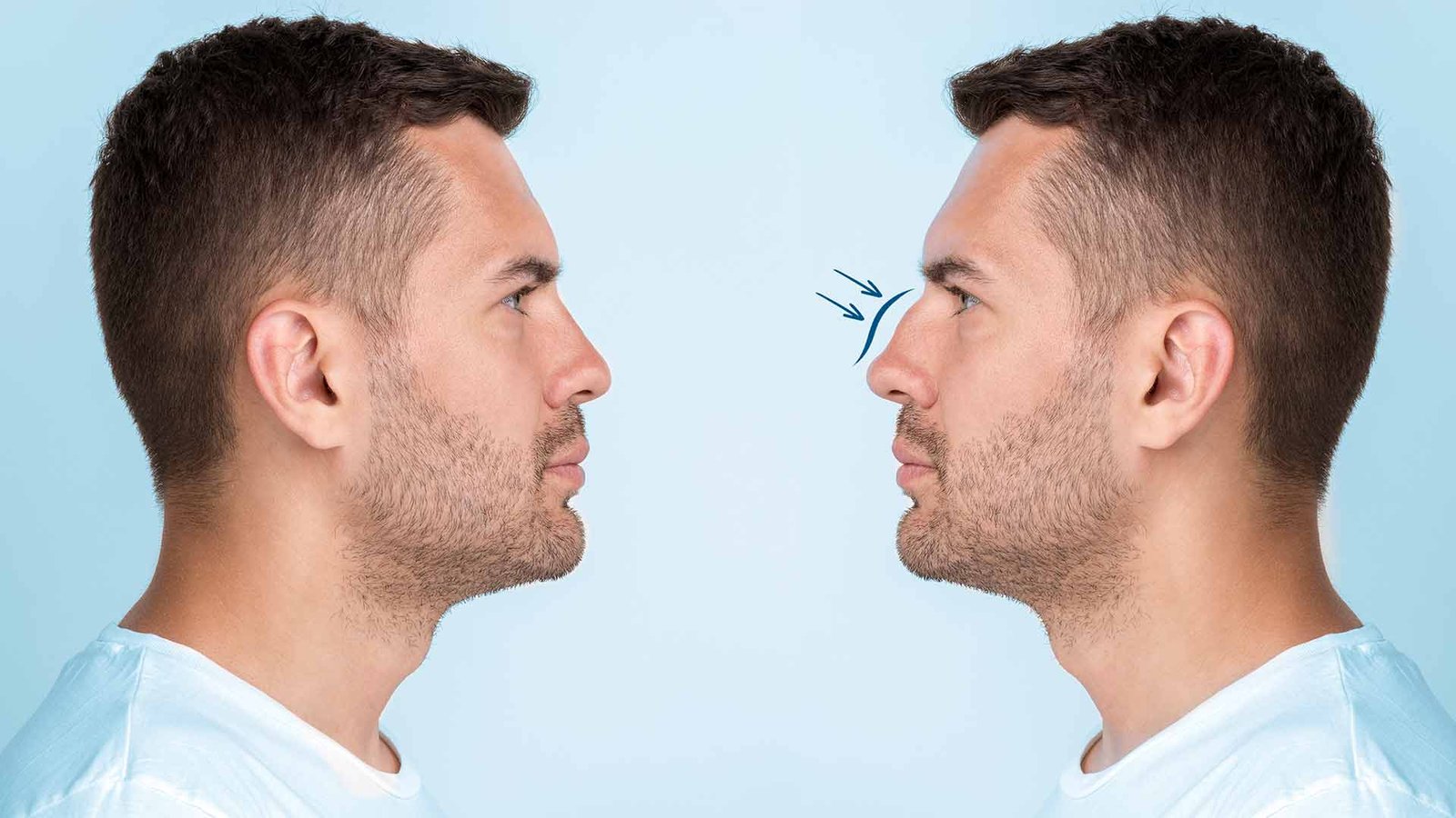 Plastic surgery in Turkey for rhinoplasty is extremely common.