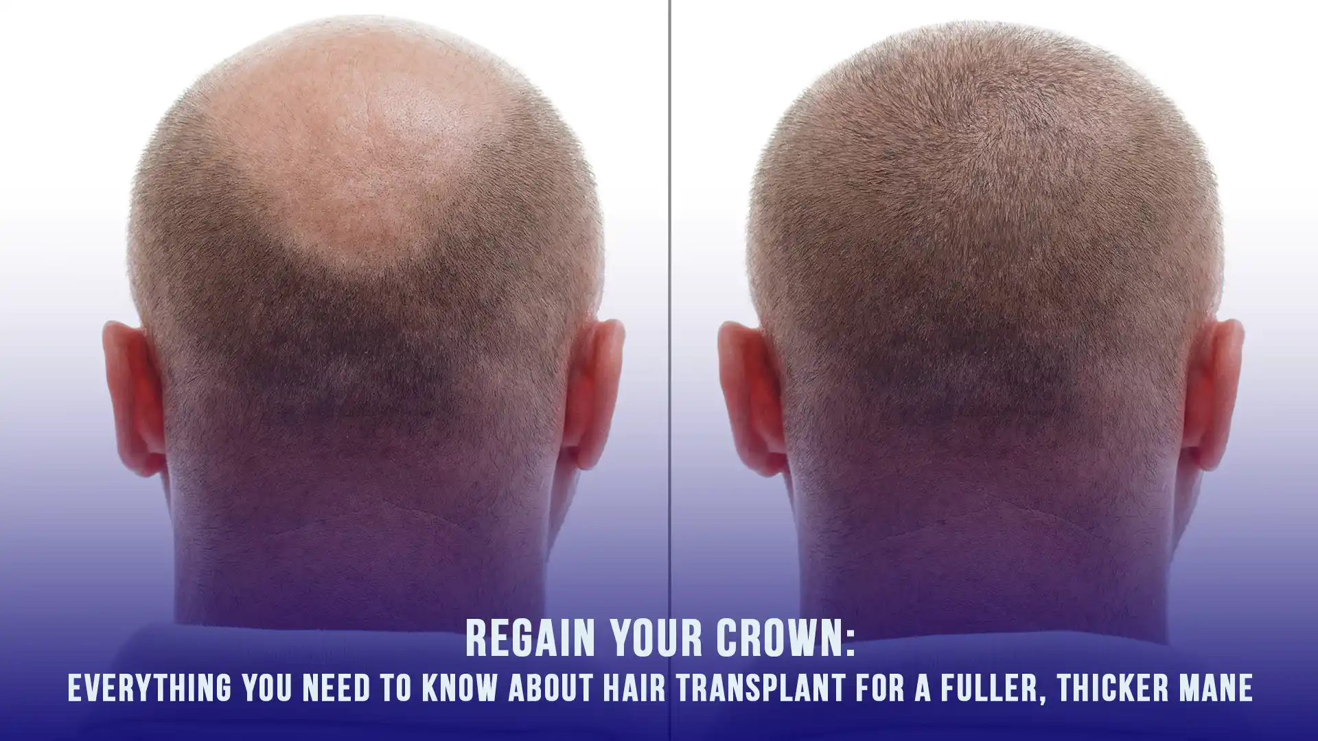 Everything you need to know about hair transplant in Turkey: Comprehensive guide covering procedures, costs, top clinics, and recovery tips.