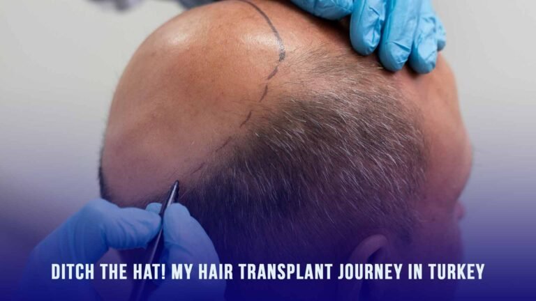 Hair transplant in Turkey: My journey to fuller hair.